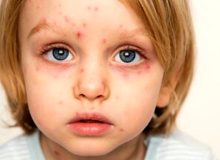 همه‌چیز در مورد یک ویروس بهاری؛ بیشتر مراقب کودکان خود باشید