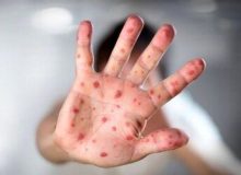 شیوع سرخک در عراق/ زائران ایرانی چه کنند؟