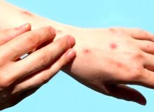 راهکار‌های پیشگیری از ابتلا به آبله میمونی