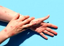 تعطیلی مدارس به‌دلیل شیوع «آبله میمونی»؟