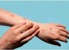 تفاوت آبله میمونی با کرونا چیست؟