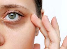بهترین درمان ها برای از بین بردن سیاهی زیر چشم