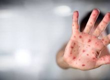 آبله میمونی؛ آیا همه گیری جدید در راه است؟