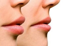 ایرانی ها برای این عمل زیبایی ۱۵۰ میلیون می دهند