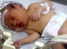 قطع نخاع نوزاد ۵ ماهه گلستانی بر اثر شکستن قلنج