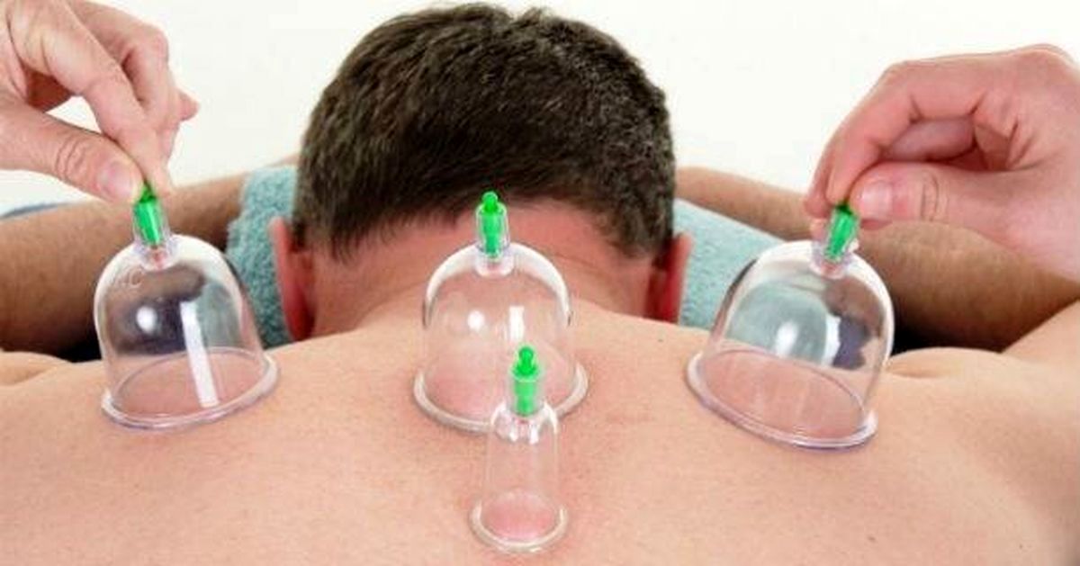 علام حق ویزیت پزشکان طب ایرانی/ حجامت مشمول بیمه شد