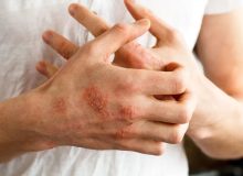 علائم حیاتی اگزما؛ چگونه بفهمیم که اگزما داریم؟
