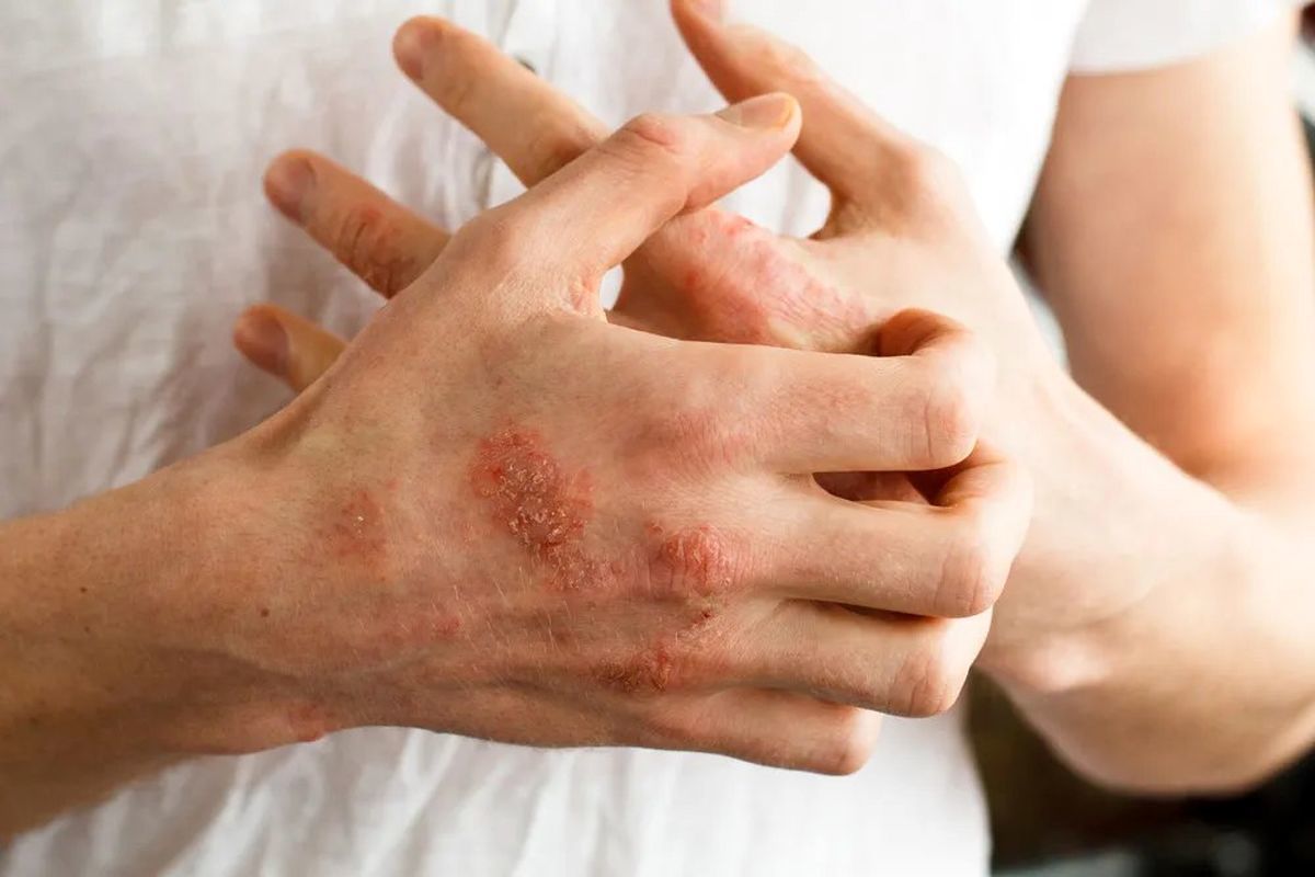 علائم حیاتی اگزما؛ چگونه بفهمیم که اگزما داریم؟