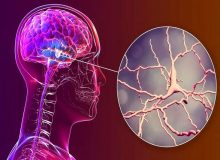 نتایج امیدوارکننده یک ساختار نانویی برای مقابله با پارکینسون