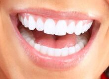 زیبایی لبخند بدون آسیب به دندان