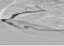 امکان افزایش دقت نمایش عروق کرونری قلب با روش‌های مبتنی بر هوش مصنوعی